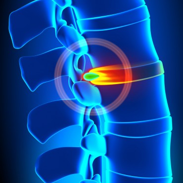 Tratamentul-herniei-de-disc