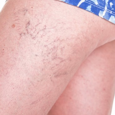 Tratamentul-venectaziilor